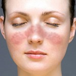 Natural treatment of Autoimmune Disorders