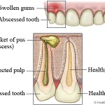 natural treatment of abscess