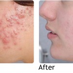 natural treatment of acne