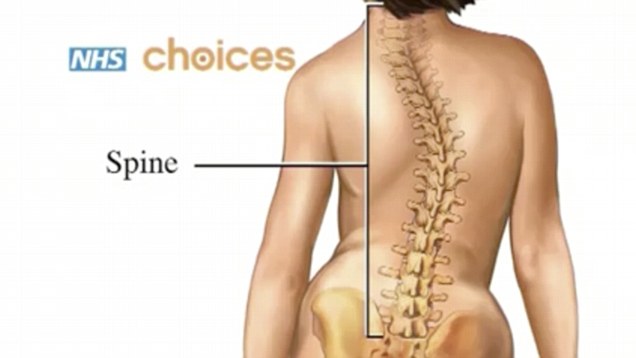 Natural alternatives for Scoliosis