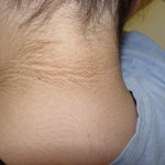 natural options for Acanthosis Nigricans