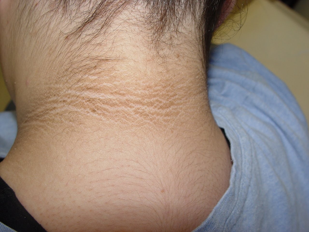 Natural options for Acanthosis Nigricans