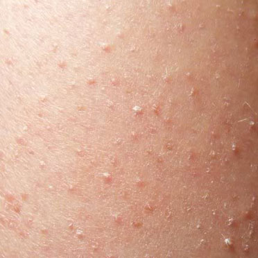 Natural cure of Keratosis Pilaris