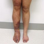 Natural options for Klippel-Trenaunay Syndrome (KTS)