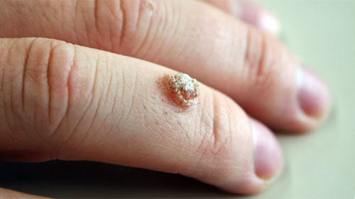 Natural cure of HPV and Warts