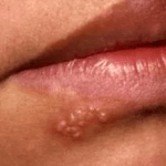 permanent natural cure for genital herpes and cold sores