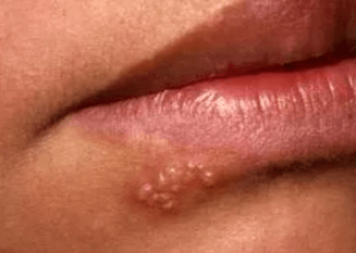 Permanent natural cure for genital herpes and cold sores