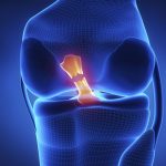 ACL tear healing without surgery