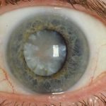 Cure Cataracts without surgery