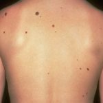 Cure Moles Without Surgery