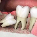 Eruption and Treatment of Impacted Wisdom Tooth without surgery