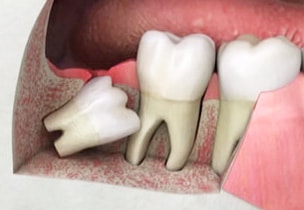 Eruption and Treatment of Impacted Wisdom Tooth without surgery
