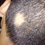 Fast Natural Permanent treatment of Alopecia